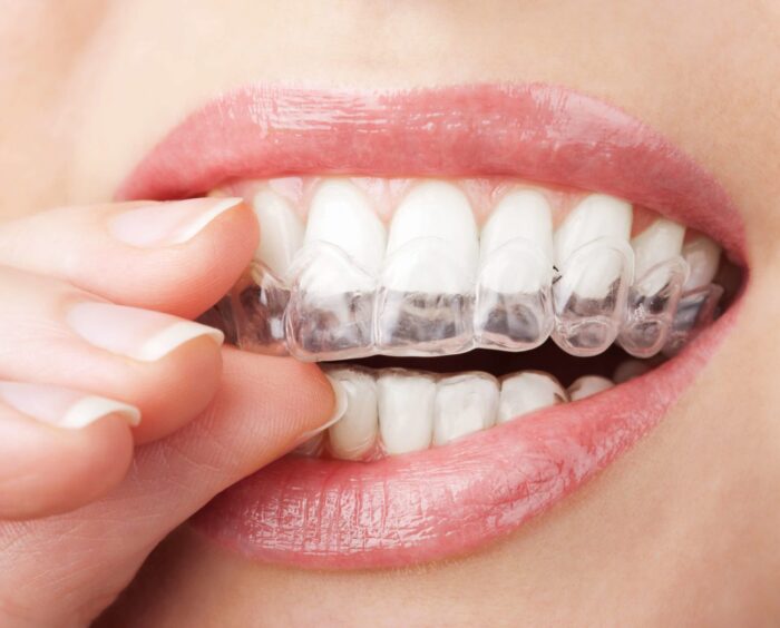 Upgrading Your Smile With Invisalign Owings Mills MD Dentist