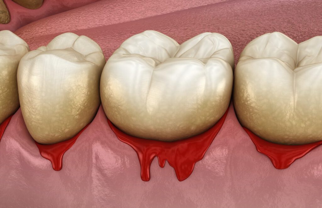 If you have bleeding gums when you brush or floss, it could be a sign of gingivitis or gum inflammation.